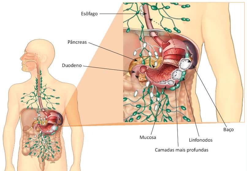 neoplasias do sistema digestivo, esquema ilustrando dentro do corpo humano no aparelho digestivo aparição de Linfonodos.