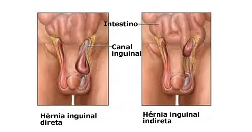 Mulheres com hérnia na virilha precisam de cirurgia de urgência em