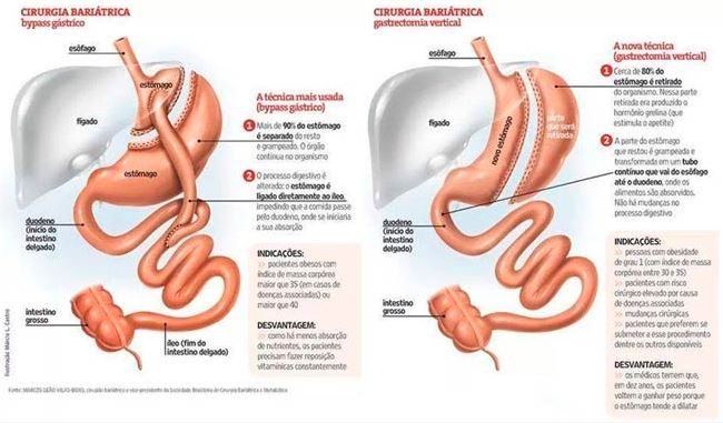 Bypass Gástrico X Sleeve qual técnica é melhor Descubra