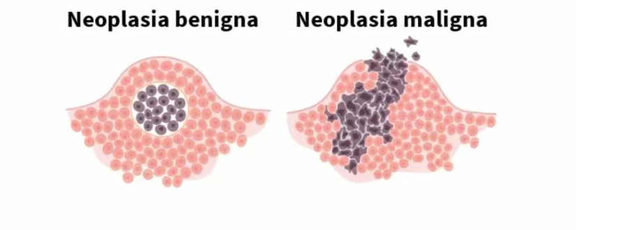 Neoplasias do Sistema Digestivo: esquema de comportamento de neoplasia celular benigna e maligna