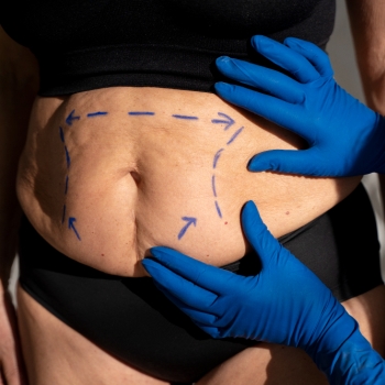 Benefícios da cirurgia bariátrica e metabólica na longevidade
