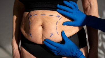 Benefícios da cirurgia bariátrica e metabólica na longevidade
