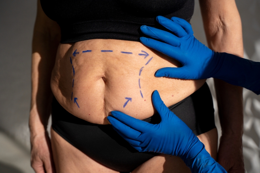 Benefícios da cirurgia bariátrica e metabólica na longevidade