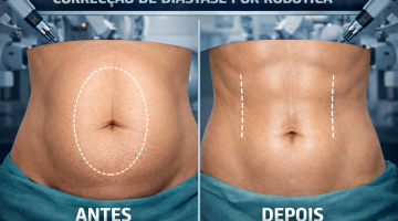 CIRURGIA ROBÓTICA NO TRATAMENTO DA DIÁSTASE DE RETOS ABDOMINAIS E HÉRNIAS VENTRAIS