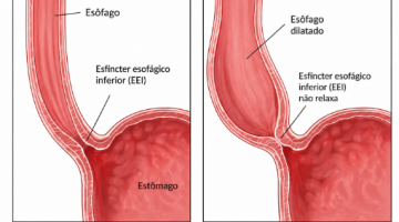 TRATAMENTO CIRÚRGICO DA ACALÁSIA (MEGAESÔFAGO)